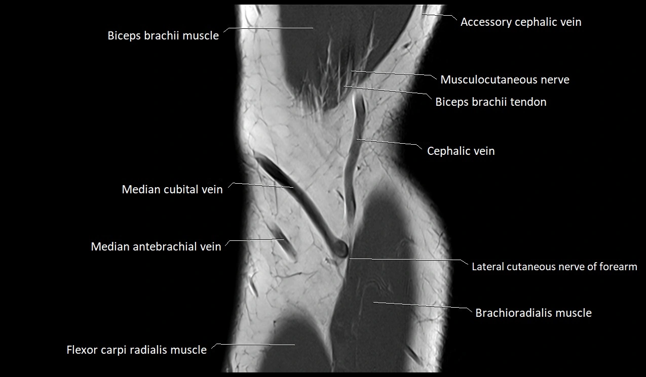 Elbow coronal anatomy image  cross sectional 3T MRI image 5.webp